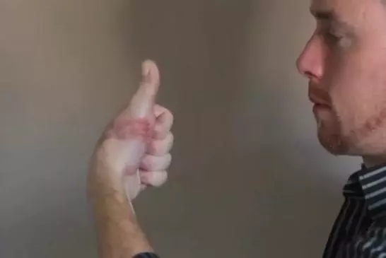 James Byrne se fait greffer un orteil à la place du pouce après un accident !