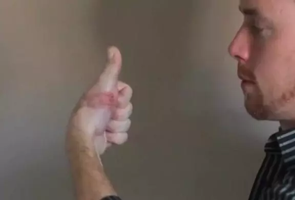 James Byrne se fait greffer un orteil à la place du pouce après un accident !