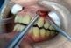 Un dentiste filme son opération sur un patient atteint d’un abcès dentaire !