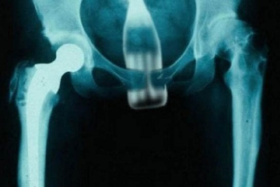 What Should Extract From This X Ray